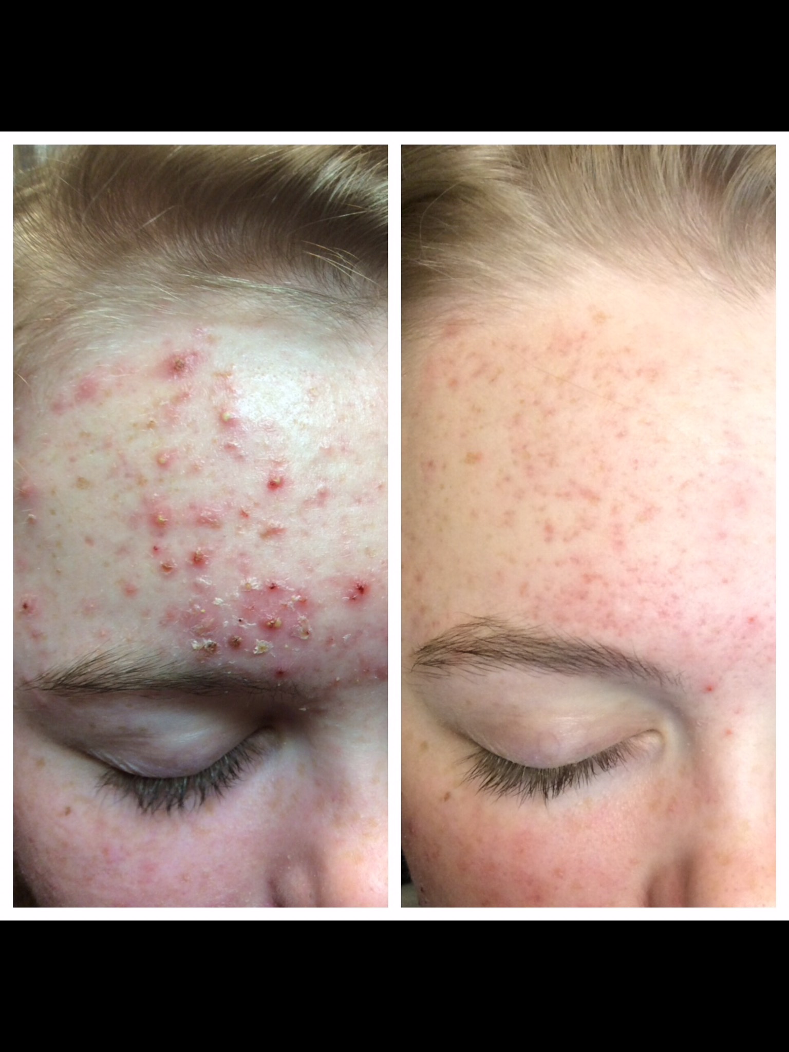 When Acne Strikes, Choose Aerolase | Amani MedSpa